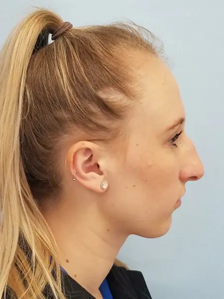 Rhinoplasty — before, right profile — Dr. Faramarz Shabdiz, MD. Individual results vary.