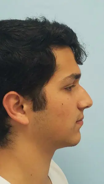 Rhinoplasty — before, right profile — Dr. Faramarz Shabdiz, MD. Individual results vary.