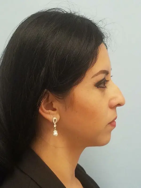 Rhinoplasty — before, right profile — Dr. Faramarz Shabdiz, MD. Individual results vary.