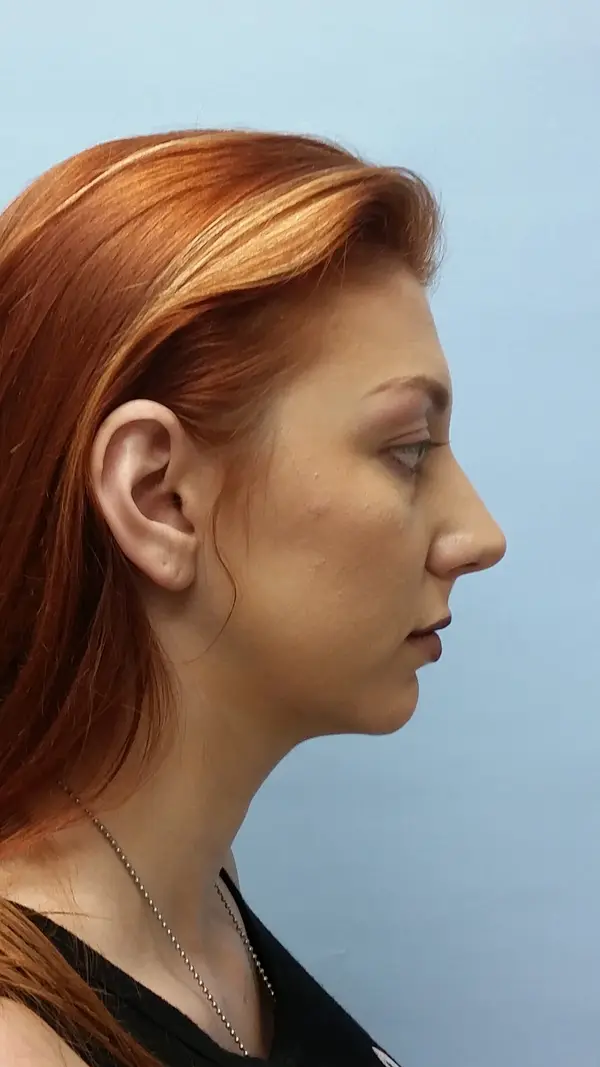 Rhinoplasty — before, right profile — Dr. Faramarz Shabdiz, MD. Individual results vary.