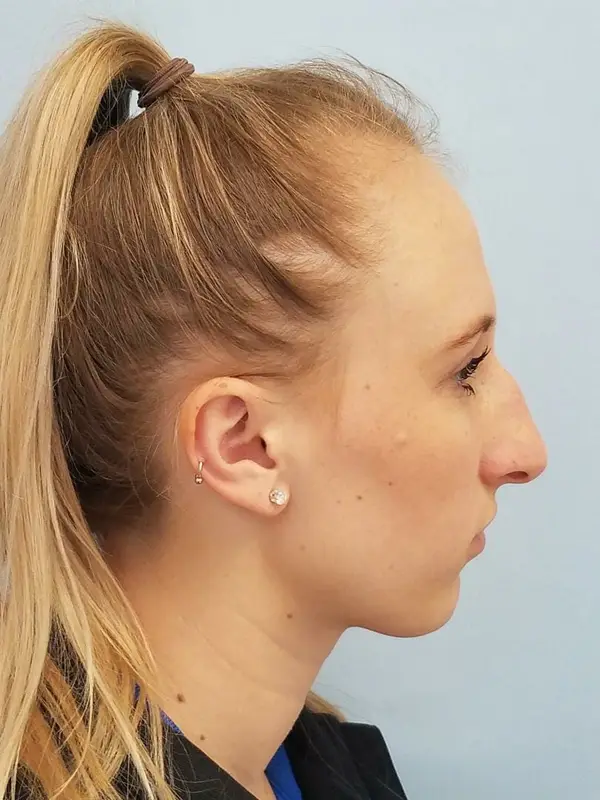 Consented standalone clinical photograph, file preop-rt; not a verified comparison