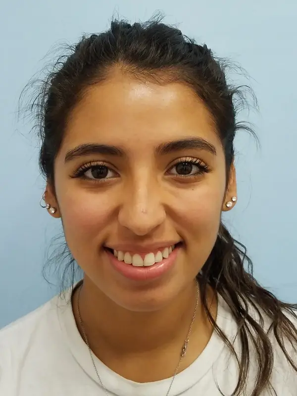 Rhinoplasty — before, smiling — Dr. Faramarz Shabdiz, MD. Individual results vary.
