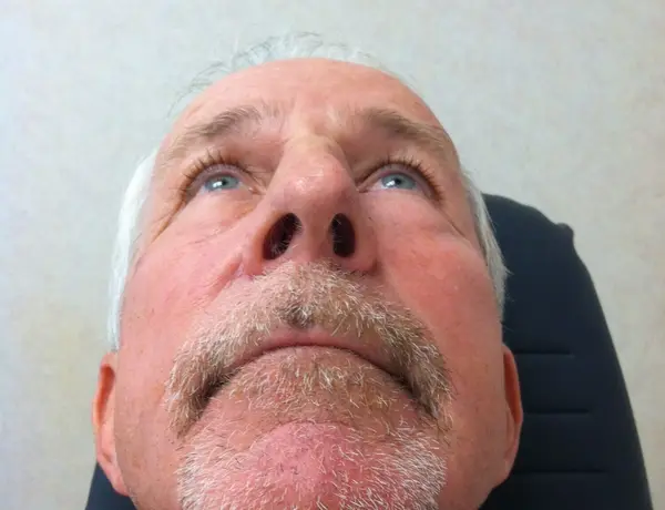 Rhinoplasty — before, base view — Dr. Faramarz Shabdiz, MD. Individual results vary.