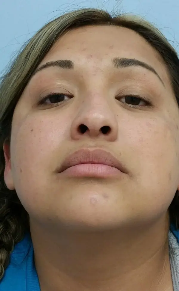 Rhinoplasty — before, base view — Dr. Faramarz Shabdiz, MD. Individual results vary.