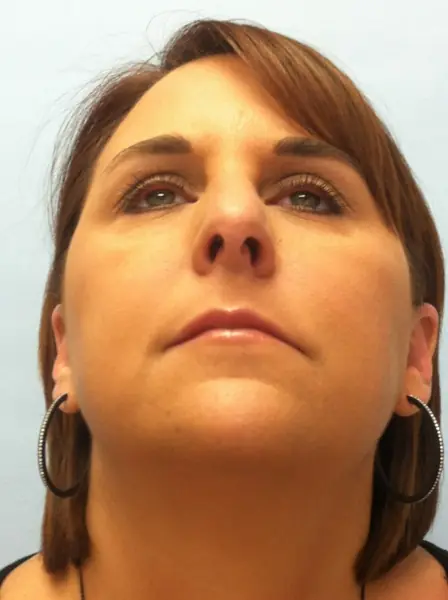 Rhinoplasty — before, base view — Dr. Faramarz Shabdiz, MD. Individual results vary.