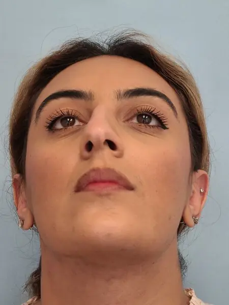 Rhinoplasty — before, base view — Dr. Faramarz Shabdiz, MD. Individual results vary.