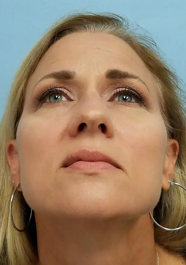 Rhinoplasty — before, base view — Dr. Faramarz Shabdiz, MD. Individual results vary.