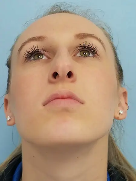Rhinoplasty — before, base view — Dr. Faramarz Shabdiz, MD. Individual results vary.
