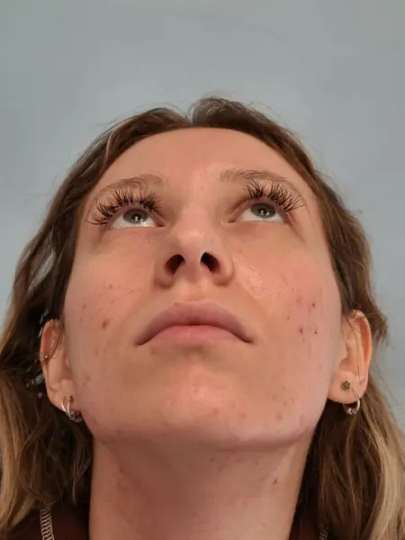 Rhinoplasty — before, base view — Dr. Faramarz Shabdiz, MD. Individual results vary.