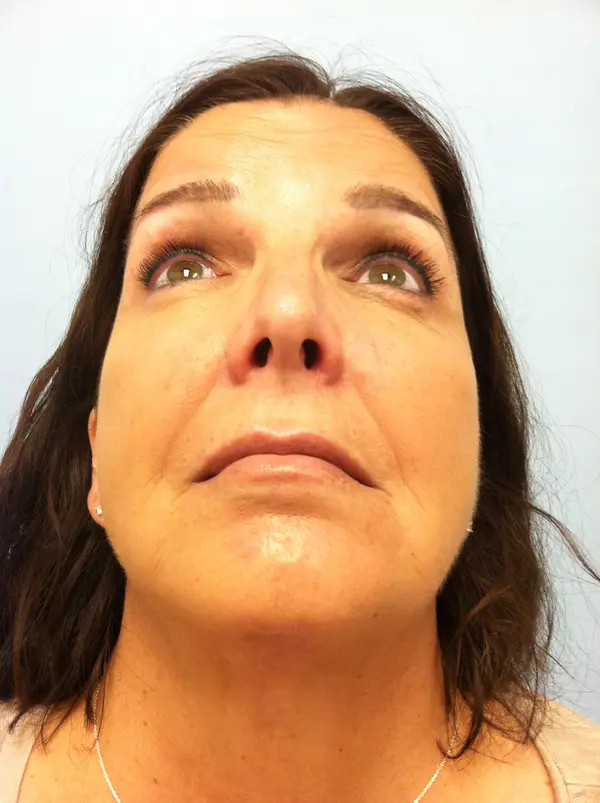 Facial Tumor & Reconstruction — before photo, base view, Dr. Faramarz Shabdiz, MD, Orange County, CA. Individual results vary.