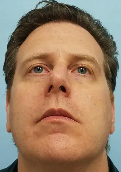 Rhinoplasty — before, base view — Dr. Faramarz Shabdiz, MD. Individual results vary.