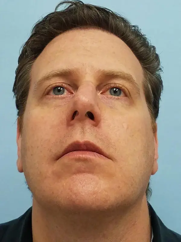 Rhinoplasty — before photo, base view, Dr. Faramarz Shabdiz, MD, Orange County, CA. Individual results vary.