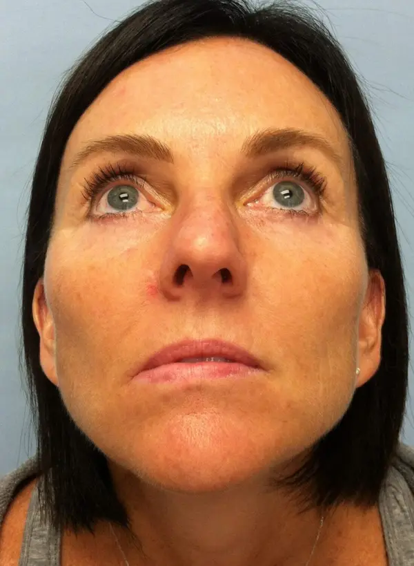 Rhinoplasty — before, base view — Dr. Faramarz Shabdiz, MD. Individual results vary.