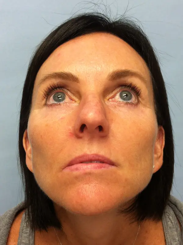 Rhinoplasty — before photo, base view, Dr. Faramarz Shabdiz, MD, Orange County, CA. Individual results vary.