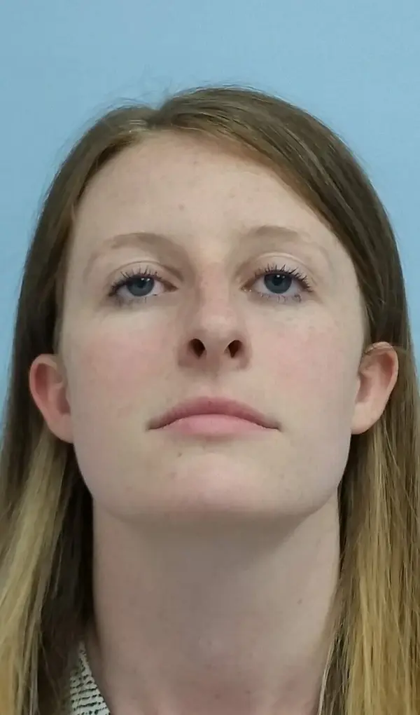 Rhinoplasty — before, base view — Dr. Faramarz Shabdiz, MD. Individual results vary.