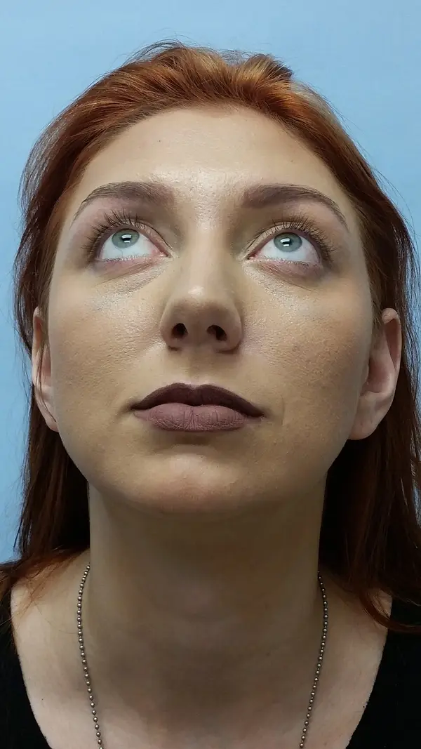 Rhinoplasty — before photo, base view, Dr. Faramarz Shabdiz, MD, Orange County, CA. Individual results vary.