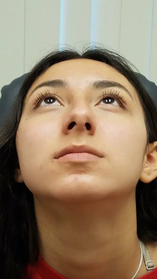 Rhinoplasty — before photo, base view, Dr. Faramarz Shabdiz, MD, Orange County, CA. Individual results vary.