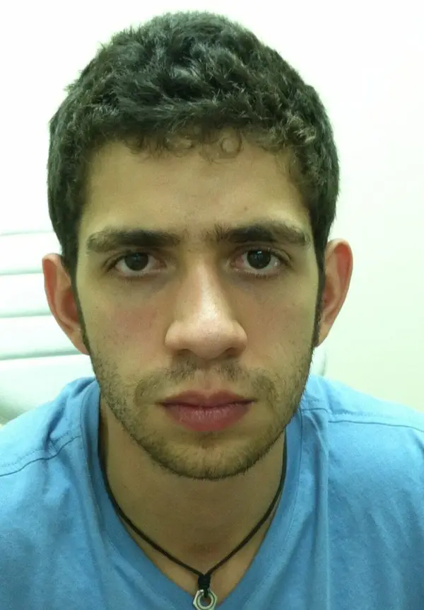 Rhinoplasty — before — Dr. Faramarz Shabdiz, MD. Individual results vary.