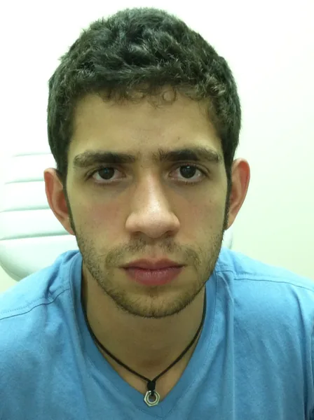 Additional Results — before photo, Dr. Faramarz Shabdiz, MD, Orange County, CA. Individual results vary.