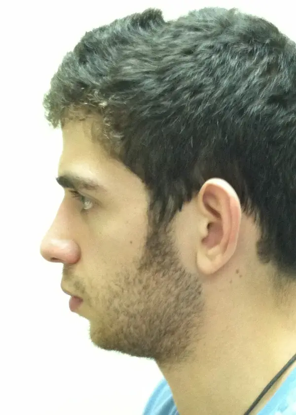 Rhinoplasty — before photo, Dr. Faramarz Shabdiz, MD, Orange County, CA. Individual results vary.