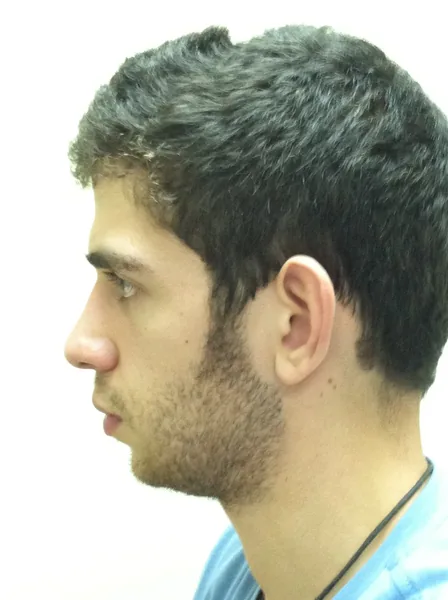 Additional Results — before photo, Dr. Faramarz Shabdiz, MD, Orange County, CA. Individual results vary.