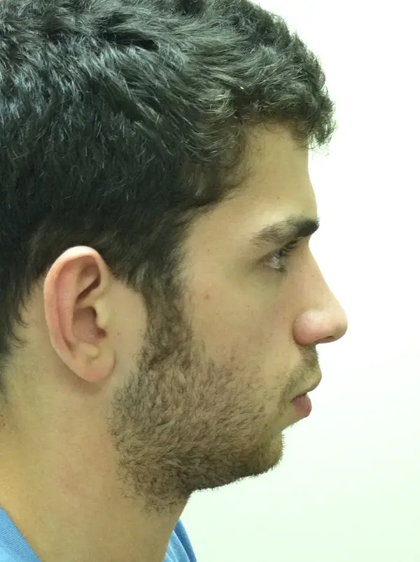 Rhinoplasty — before — Dr. Faramarz Shabdiz, MD. Individual results vary.