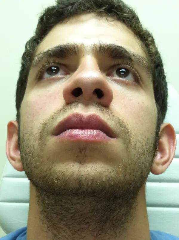 Rhinoplasty — before — Dr. Faramarz Shabdiz, MD. Individual results vary.