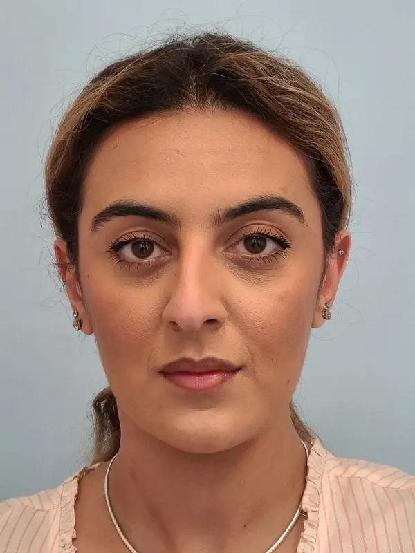 Rhinoplasty — before, front — Dr. Faramarz Shabdiz, MD. Individual results vary.