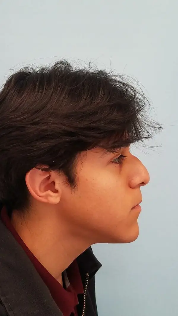 Rhinoplasty — before, right profile — Dr. Faramarz Shabdiz, MD. Individual results vary.