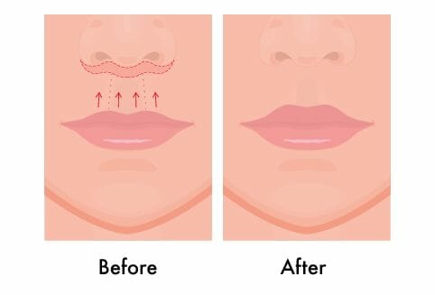 Surgical Lip Lift